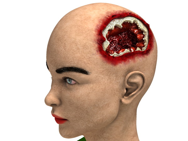 obj bust girl severe head - Girl with severe Head Injury... by scyrus