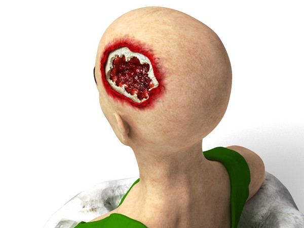 obj bust girl severe head - Girl with severe Head Injury... by scyrus