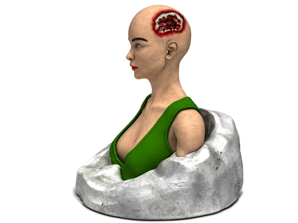 obj bust girl severe head - Girl with severe Head Injury... by scyrus