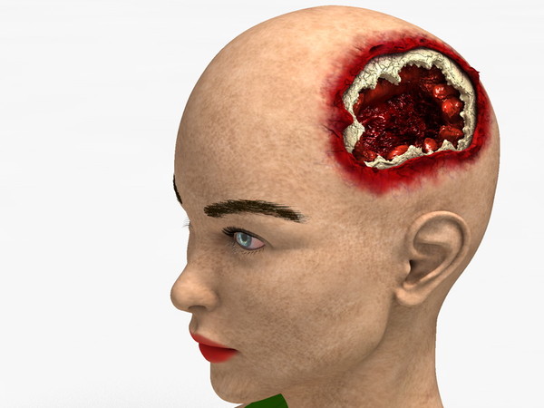 obj bust girl severe head - Girl with severe Head Injury... by scyrus