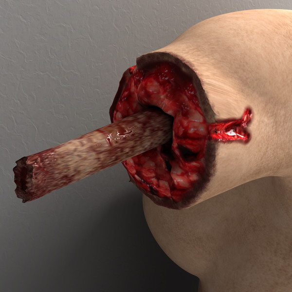 mutilated female corpse 3d model - Mutilated Corpse Body Female... by scyrus